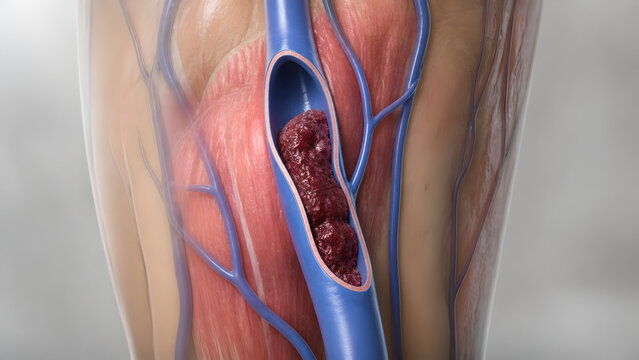 Vein Cross-Section Eccentric Thrombus Partial Luminal Narrowing 3D Medical Cutaway Vascular Anatomy