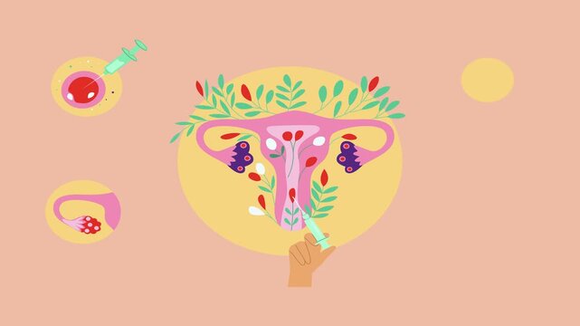 The stages of artificial insemination of the female uterus, involving the introduction of sperm into the egg via a syringe injection. Vector animation in flat art style