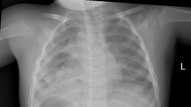 Chest X-ray opaque right lung shoulder dislocation. Pediatric thoracic radiography showing pulmonary opacity in right lung field and shoulder joint misalignment for medical diagnostic education
