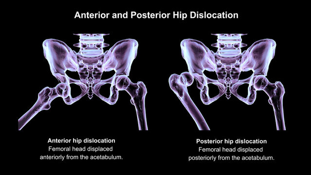 Hip dislocation, 3D illustration comparing anterior and posterior displacement of the femoral head relative to the acetabulum