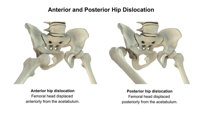 Hip dislocation, 3D illustration comparing anterior and posterior displacement of the femoral head relative to the acetabulum