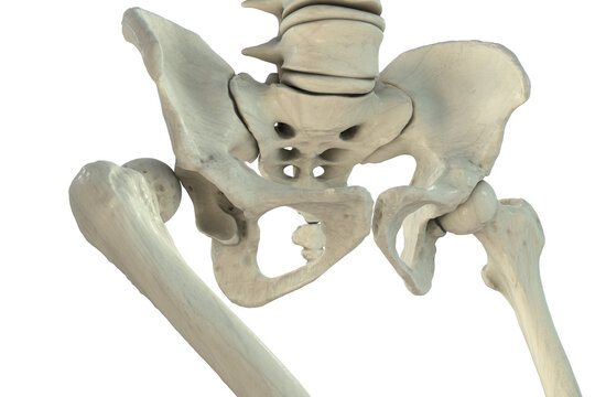 Hip dislocation, 3D illustration showing posterior displacement of the femoral head from the acetabulum, with pelvis and proximal femur, isolated medical depiction of traumatic hip joint injury