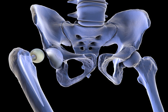 Posterior dislocation of total hip replacement, 3D illustration showing posterior displacement of the prosthetic femoral head from the acetabular component, isolated medical depiction