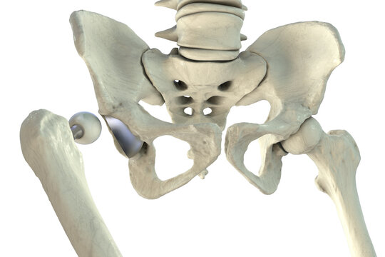 Posterior dislocation of total hip replacement, 3D illustration showing posterior displacement of the prosthetic femoral head from the acetabular component, isolated medical depiction