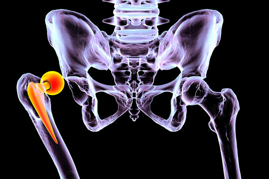 Posterior dislocation of unipolar hip hemiarthroplasty, 3D illustration showing posterior displacement of the prosthetic femoral head from the native acetabulum, isolated medical depiction