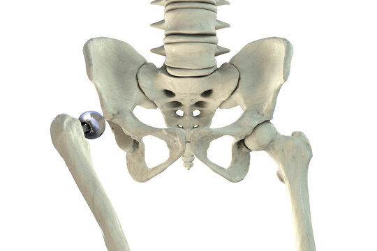 Posterior dislocation of unipolar hip hemiarthroplasty, 3D illustration showing posterior displacement of the prosthetic femoral head from the native acetabulum, isolated medical depiction