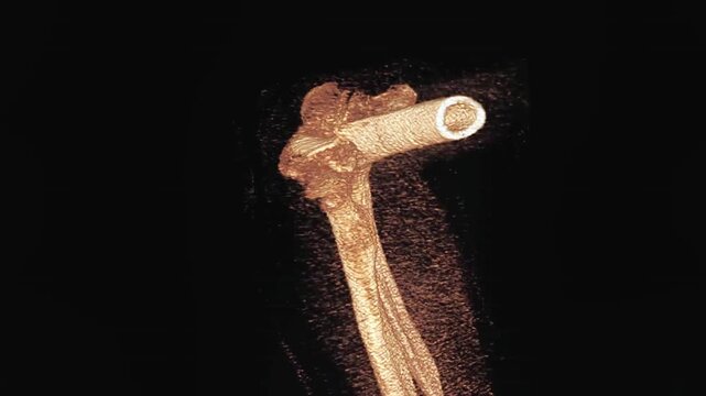Humerus fracture surgery stabilization 3D computed tomography reconstruction. Orthopedic surgical planning visualization showing internal fixation hardware for proximal humerus bone trauma recovery an