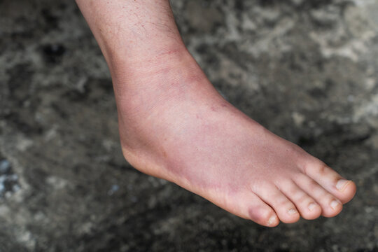 Swollen Foot After Cast Removal of Metatarsal Fracture