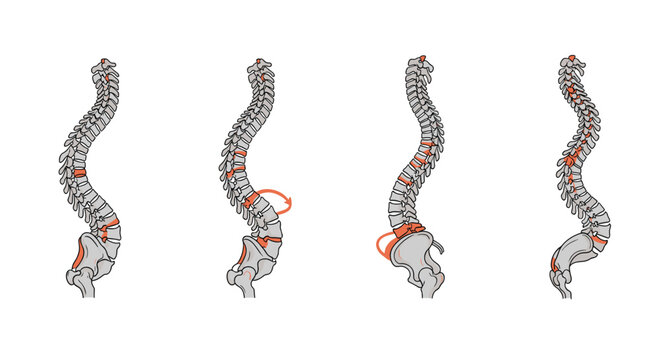 Set of four human spinal column illustrations showing different types of postural abnormalities and vertebral conditions.