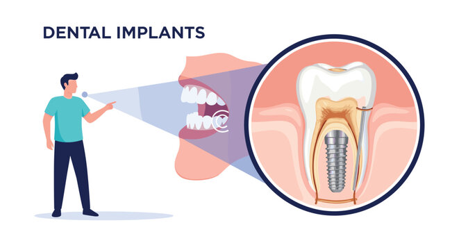Educational illustration of a dental implant procedure showing a man pointing to a detailed tooth implant structure in a jaw.