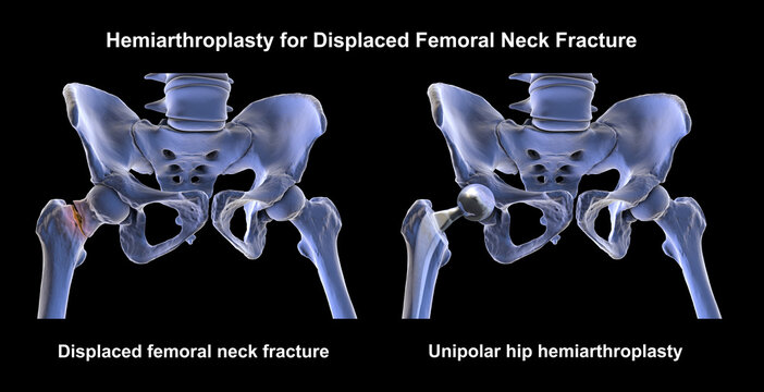 Displaced femoral neck fracture with visible shift of the femoral head and unipolar hemiarthroplasty prosthesis with large single femoral head and femoral stem in situ, 3D illustration