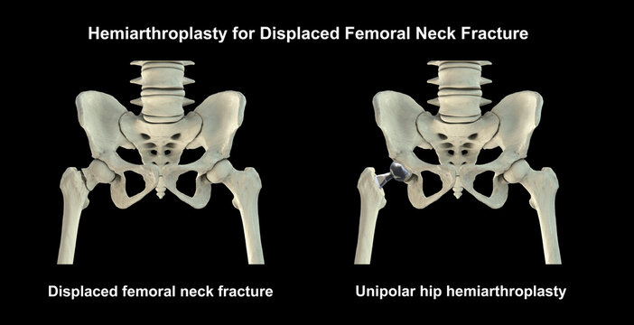 Displaced femoral neck fracture with visible shift of the femoral head and unipolar hemiarthroplasty prosthesis with large single femoral head and femoral stem in situ, 3D illustration