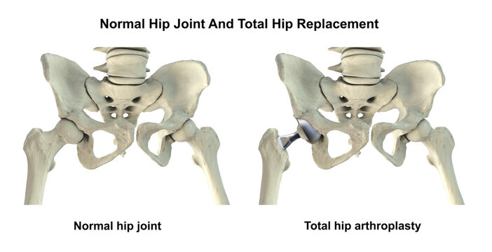 Normal healthy hip joint with intact femoral head, acetabulum, articular cartilage and joint space, and total hip replacement, 3D illustration.