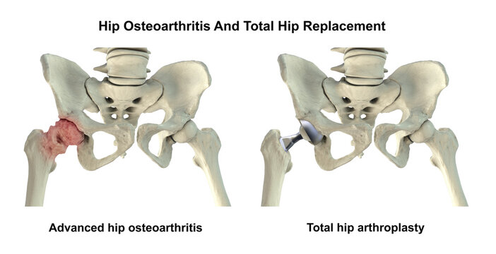 Advanced hip osteoarthritis with joint space narrowing, osteophytes and cartilage loss, and total hip replacement prosthesis, 3D illustration.