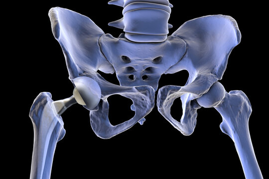 Total hip replacement prosthesis. Shows femoral stem with head, acetabular cup with liner, and articulation in the hip joint. 3D illustration.