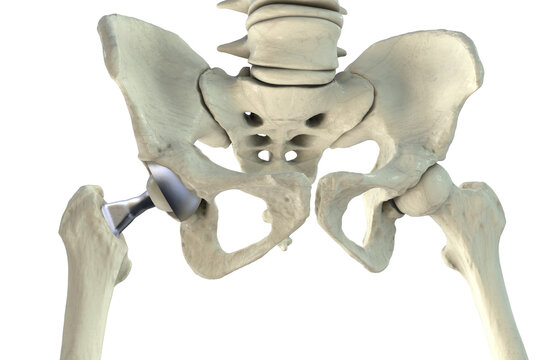 Total hip replacement prosthesis. Shows femoral stem with head, acetabular cup with liner, and articulation in the hip joint. 3D illustration.