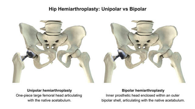 Three types of hip prostheses: unipolar hemiarthroplasty, bipolar hemiarthroplasty and total hip replacement, 3D illustration