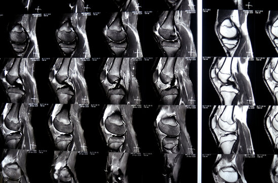 MRI of the right knee with patellofemoral nodular soft tissue thickenings, subcortical marrow edema, contusion of the lower patellar poles, Grade 2 signal of the posterior horn of the medial meniscus