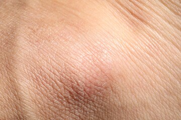 Fototapeta premium Man with dry skin on his hand, closeup