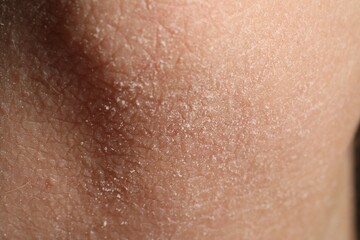 Fototapeta premium Texture of dry skin as background, closeup