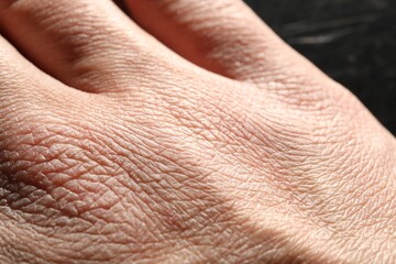 Naklejka premium Man with dry skin on his hand against blurred background, closeup
