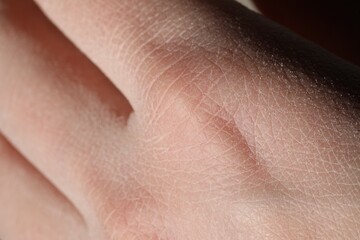 Naklejka premium Man with dry skin on his hand, closeup