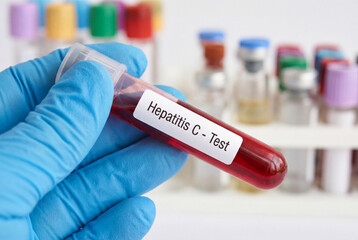 Obraz premium Doctor holding a blood sample in a test tube for a hepatitis c virus screening