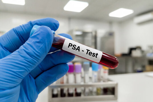 PSA blood test sample in a tube for prostate cancer screening held by a gloved hand