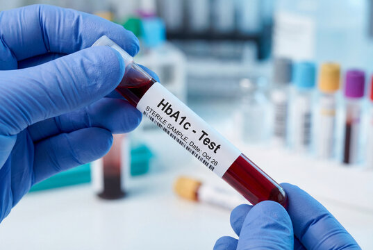 Doctor holding a blood sample for an hba1c test to diagnose and monitor diabetes