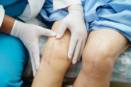 Doctor checking Asian elderly woman patient with scar knee replacement surgery in hospital.