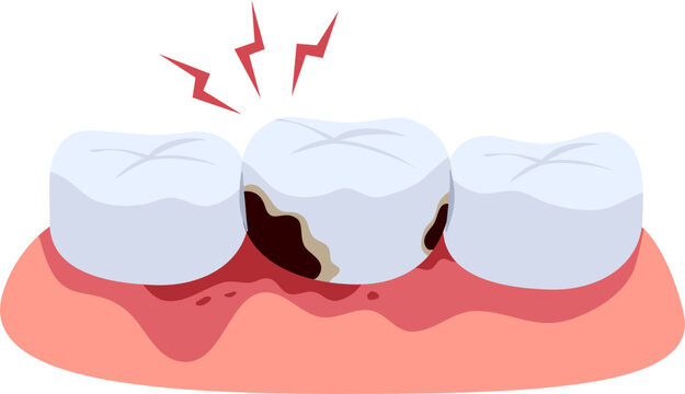 Human tooth decay with cavity and dental caries illustration
