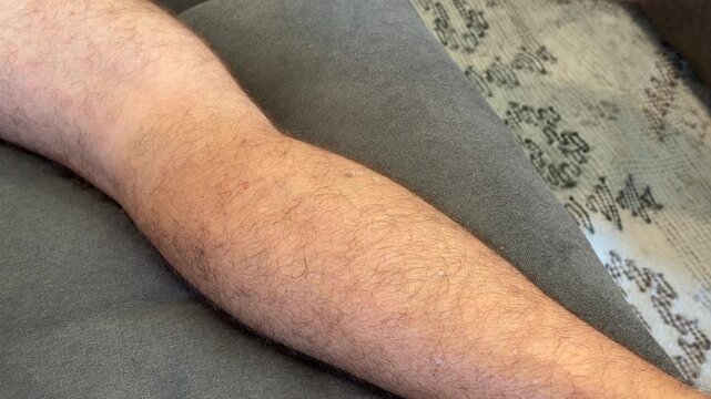 Attempting to freeze a tick burrowed into a man's leg in 4k video footage