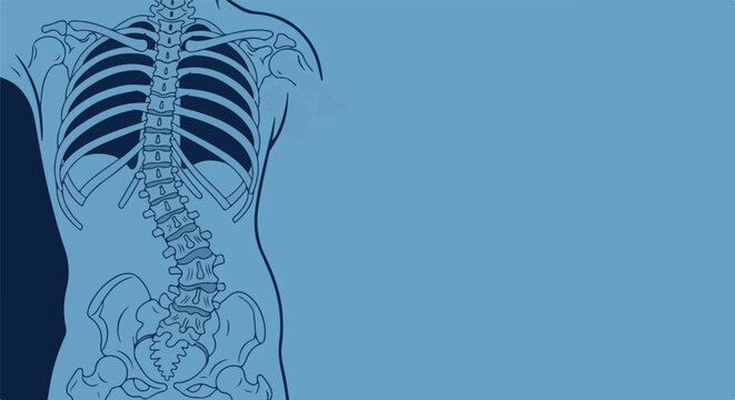 Detailed illustration of a human torso skeleton showing scoliosis, medical depiction