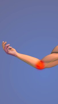 Cubital tunnel syndrome medical concept