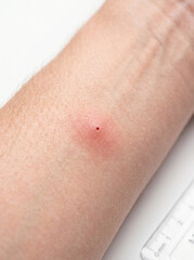 Fototapeta premium Close-Up Image of Small Skin Puncture with Redness and Blood on Forearm Surface