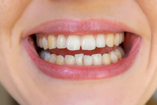 Close-up of teeth showcasing natural tooth coloration and dental alignment