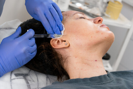 Biorevitalization injections to enhance skin firmness and moisture balance. Biorevitalization injections provide deep moisturizing. Facial biorevitalization to restore hydration and elasticity