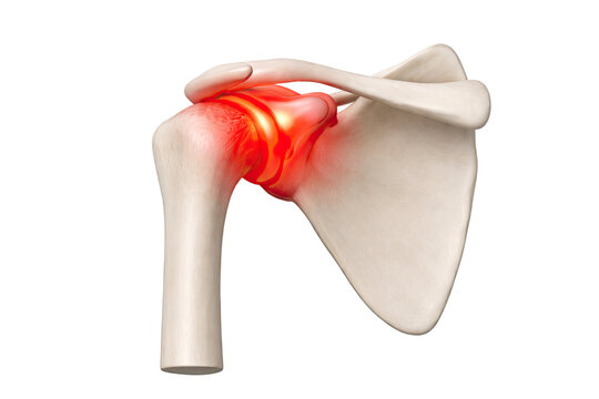 Shoulder joint anatomy medical illustration showing inflamed rotator cuff bones scapula clavicle humerus pain area orthopedic condition isolated on white background