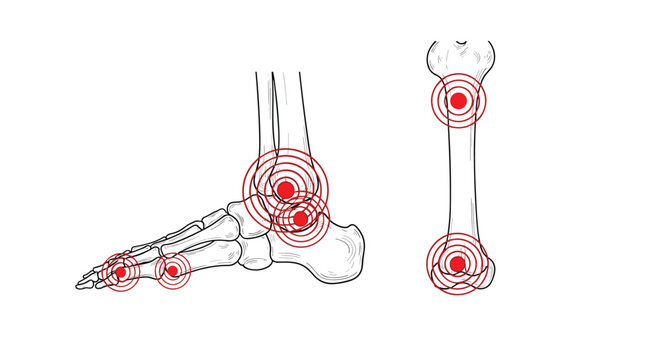 Anatomical drawing of human foot and ankle bones showing painful areas marked with red concentric circles for medical diagnosis.