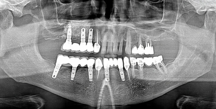 dental x ray , implant , chronic inflammatory disease , bacterial infection , bleeding gums , tooth mobility , bone loss , gum recession , 
