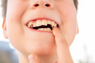 Fototapeta premium Close up child mouth showing damaged tooth and pointing finger, dental health problem, cavity and poor oral hygiene, pediatric dentistry, need for treatment, tooth decay awareness, dentist visit