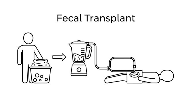 Fecal Microbiota Transplant (FMT) medical procedure infographic.