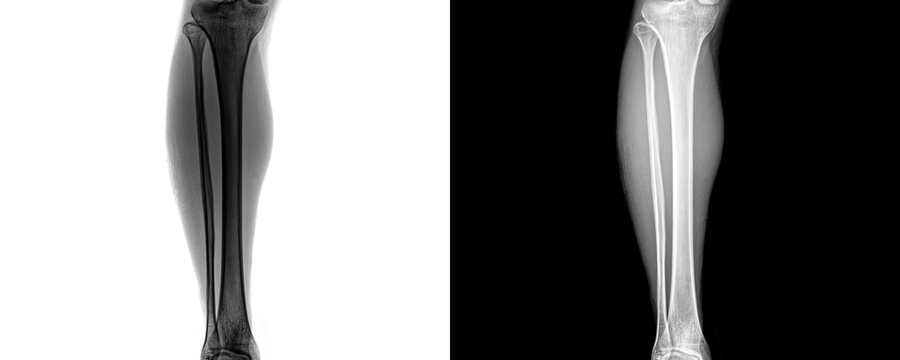 Diagnostic Leg Anterior Projection X-Ray Image Displaying Bone Structure and Alignment for Evaluation of Fractures and Traumatic Injuries Isolated on Transparent Background