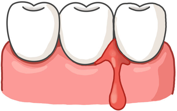 Bleeding Gums