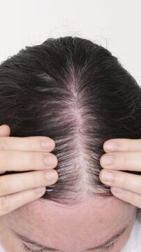 Woman controls hair loss and little volume with fine hair