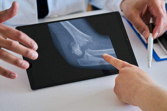 Doctor shows a tablet for x ray with child broken elbow, scan or osteoporosis with point at hospital. Application and ux for medical consultation for broken elbow, feedback or report at clinic
