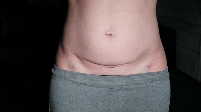 Fresh medical scars on female abdomen after laparoscopic surgery. Stretch marks on light caucasian skin after cesarean section on dark background. Body Lymphatic edema. Maternity concept. Front view.