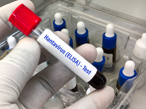 Biological Specimen blood test for detecting IgM and IgG antibodies (ELISA) or molecular PCR tests to detect viral RNA of Orthohantavirus or Hantavirus.