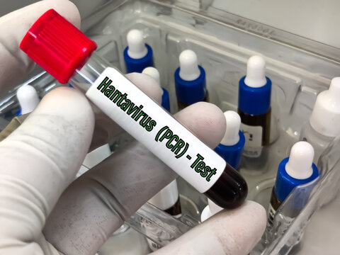 Biological Specimen blood test for detecting IgM and IgG antibodies (ELISA) or molecular PCR tests to detect viral RNA of Orthohantavirus or Hantavirus.