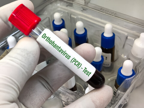 Biological Specimen blood test for detecting IgM and IgG antibodies (ELISA) or molecular PCR tests to detect viral RNA of Orthohantavirus or Hantavirus.